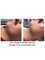 Dr. Doris Anti-Ageing Clinic - Non-Surgical Neck lift with small amount of fat reduction 