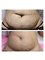 Dr. Doris Anti-Ageing Clinic - Stretch mark treatment, photo taken 4 weeks after 1 st session, visible impovement on skin tightening as well as significant reduction of stretch marks, 6 sessions are normally recommended. 