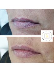 Lip filler - dermal fillers - Dr Raquel Skin & Medical Cosmetics