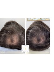 Treatment for Male Pattern Baldness - Dr Raquel Skin & Medical Cosmetics