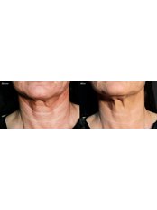 Neck Lines- dermal fillers - Dr Raquel Skin & Medical Cosmetics