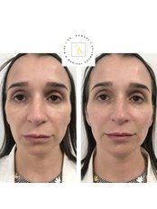 Cheek filler- dermal fillers - Dr Raquel Skin & Medical Cosmetics