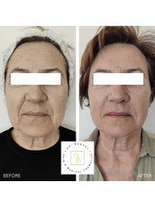 Non-Surgical Facelift with dermal fillers - Dr Raquel Skin & Medical Cosmetics