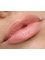 Kent and Surrey Aesthetics - Dermal Filler Lips 