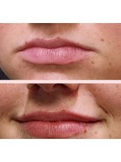 Lip Augmentation - LB Aesthetics Clinic & Training