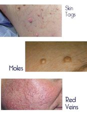 Skin Blemishes Removal (appointment) - About Face Electrolysis