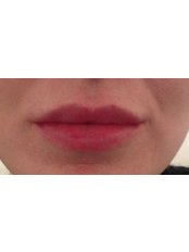 Lip Filler - Age Refined Medical Cosmetic Centre