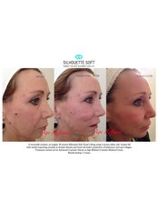Thread Lift - Age Refined Medical Cosmetic Centre
