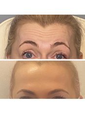 Treatment for Wrinkles - The Beauty Doctor Glasgow