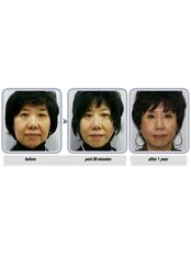 Non-Surgical Facelift - Essence Medical