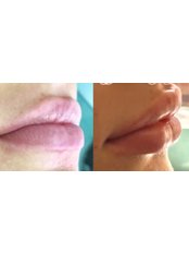 Lip Augmentation - Peppermint Cosmetic Clinics