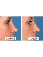 Non-Surgical Nose Job - Revitalize Medical Aesthetics