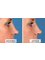 Revitalize Medical Aesthetics - Non-Surgical Rhinoplasty with Dermal Fillers 