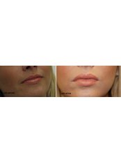 Lip Augmentation - Luxe Skin