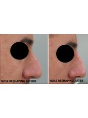 Non-Surgical Nose Job - Luxe Skin