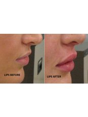 Lip Augmentation - Luxe Skin