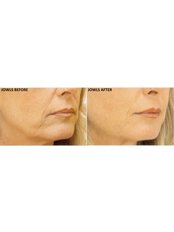 Chin Augmentation - Luxe Skin