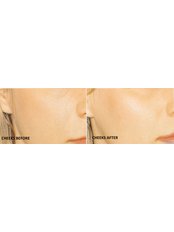 Cheek Augmentation  - Luxe Skin