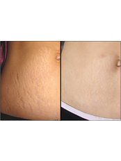 Carboxy Therapy Leg Stretch Marks from - Strathearn Health and Beauty