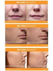 Facial Fillers 1ml - Strathearn Health and Beauty
