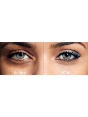 Carboxy Eyes Treatment - Strathearn Health and Beauty