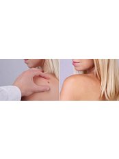 Minor Surgery Consultation for Lesion removal - Strathearn Health and Beauty