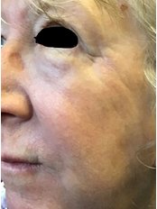 Laser Skin Resurfacing - The Women’s Clinic