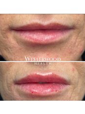 Lip Augmentation - Westerwood Health