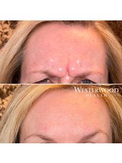 Treatment for Wrinkles - Westerwood Health