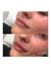 Lip Augmentation - Cosmetic Aesthetics Ltd