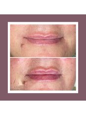 Lip Augmentation - Anais Aesthetics