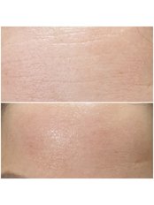 Radio Frequency Wrinkle Reduction  - Dermatight