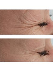 Anti Wrinkle Injections 1 Area - Lucy Aesthetics