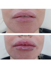 Lip Augmentation - Lucy Aesthetics
