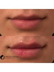 Lip Augmentation - Reflect Facial Aesthetics - Blackpool