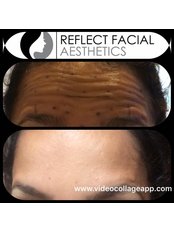 Treatment for Wrinkles- 1 Area - Reflect Facial Aesthetics - Blackpool