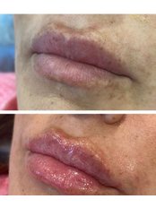 Lip Augmentation - The NewYou Skin Clinic