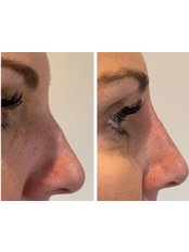 Non-Surgical Nose Job - The NewYou Skin Clinic