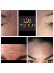 Wrinkle Treatment Injections And Treatments - Youthify Aesthetics