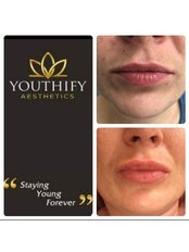 Dermal Fillers - Youthify Aesthetics