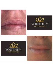 Lip Enhancement  - Youthify Aesthetics