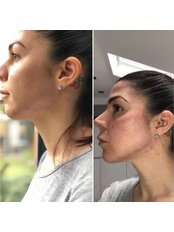 Jaw And Chin Enhancement - Youthify Aesthetics