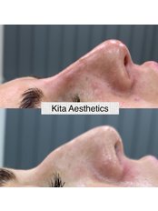 Non-Surgical Nose Job - KITA-Aesthetics