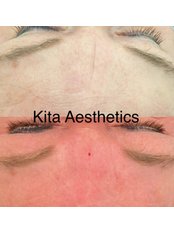 Anti Wrinkle Injections - KITA-Aesthetics