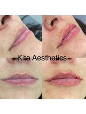 Lip Filler - KITA-Aesthetics