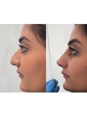 Non-Surgical Nose Job - The Look By Louise