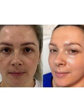 Chemical Peel - The Look By Louise