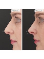 Non-Surgical Nose Job - Acuderma by Dr Koh