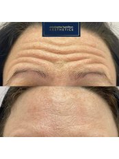 Treatment for Wrinkles 1 AREA - Antoinette Hamilton Aesthetics