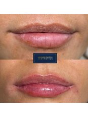 Lip Augmentation - Antoinette Hamilton Aesthetics